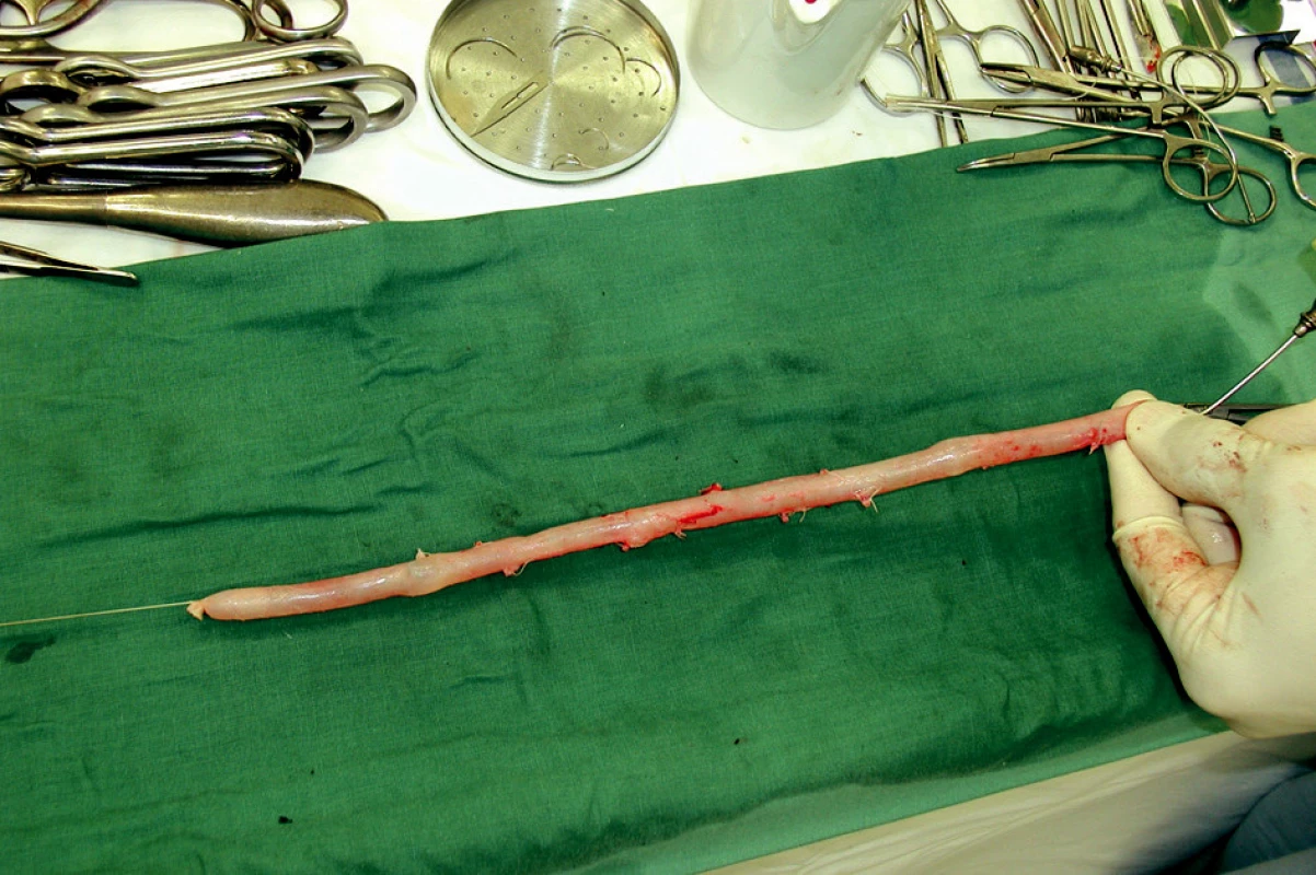 Odebraná hluboká žíla v délce 32 cm a její příprava jako štěp. Všechny větve jsou dvojitě ligovány, chlopně odstraněny. Proximálně má žíla průměr 14 mm, distálně 9 mm. To jsou ideální míry pro aorto/iliako-femorální pozici
Fig. 3. Harvested vein (32 cm long) – procedure for graft preparation. All branches are doubly ligated and valves are disrupted. A diameter of 14 mm proximally and of 9 mm distally are ideal measures for aortoiliofemoral reconstruction