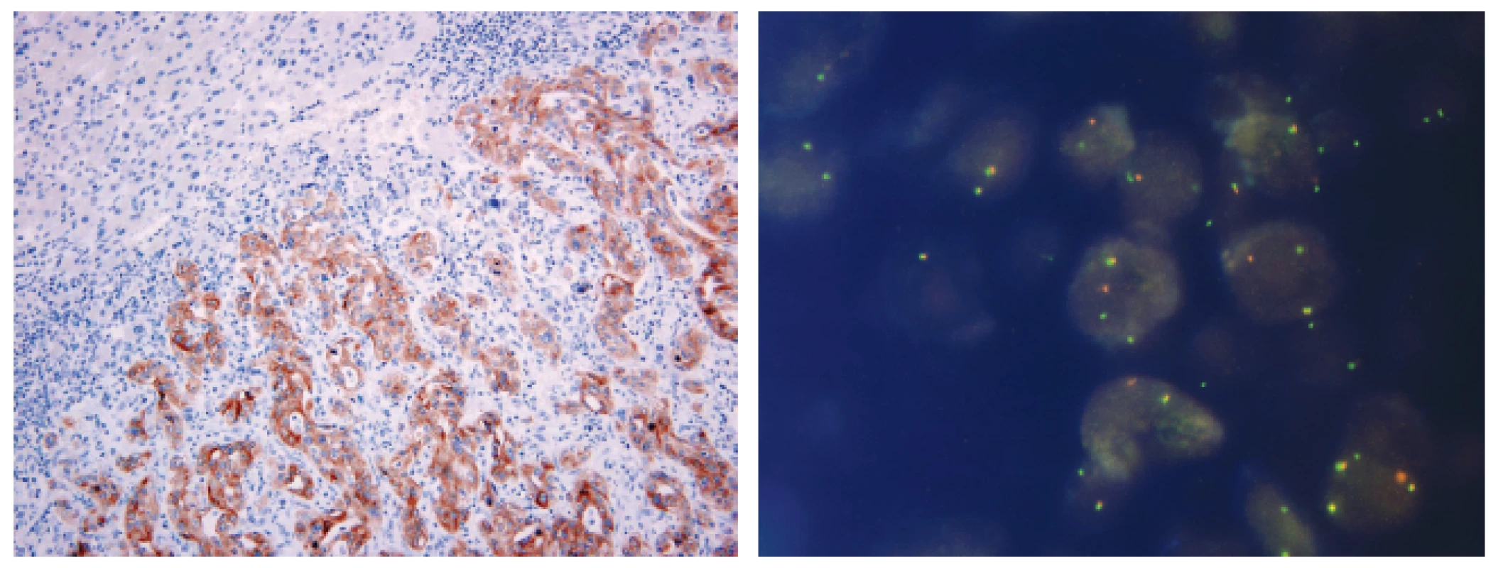 Metastáza plicního adenokarcinomu v jaterním parenchymu s přestavbou ALK pozitivní v imunohistochemickém průkazu pomocí protilátky klonu 5A4 (A) a metodou FISH (B)