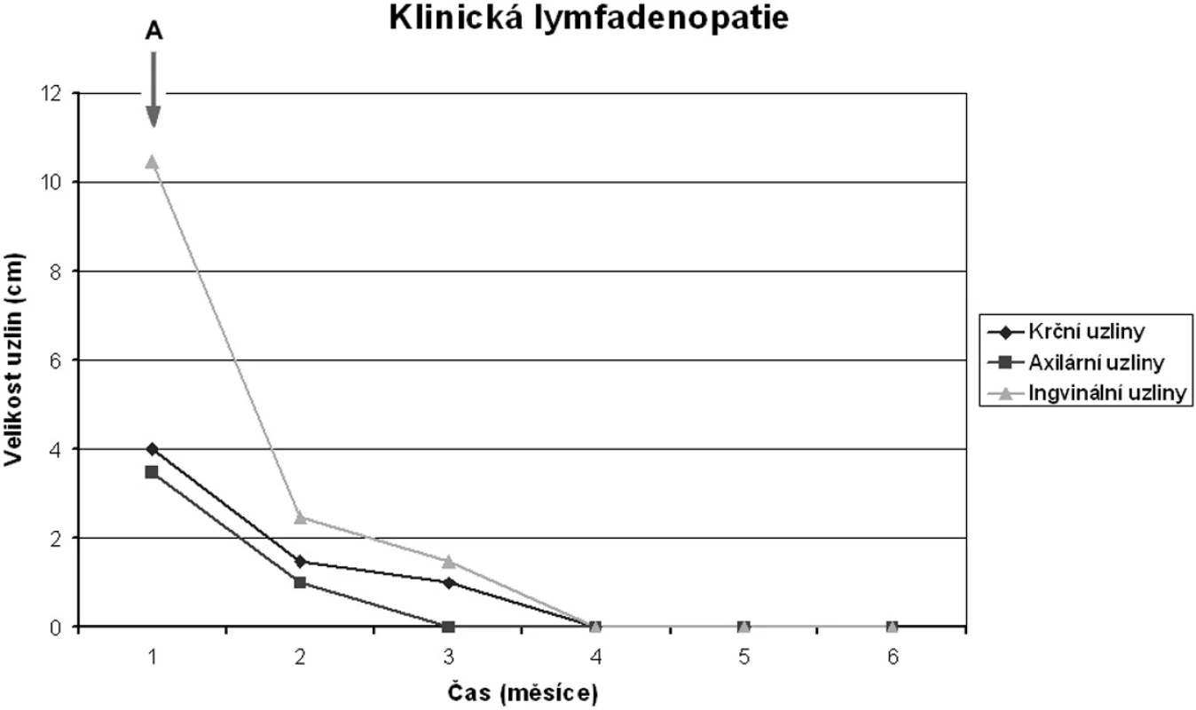 Efekt Campath-1H na velikost uzlin u pacienta 5. Šipka označuje počátek terapie alemtuzumabem. Je vidět rychlý ústup lymfadenopatie. Pacient dosáhl kompletní remise.
