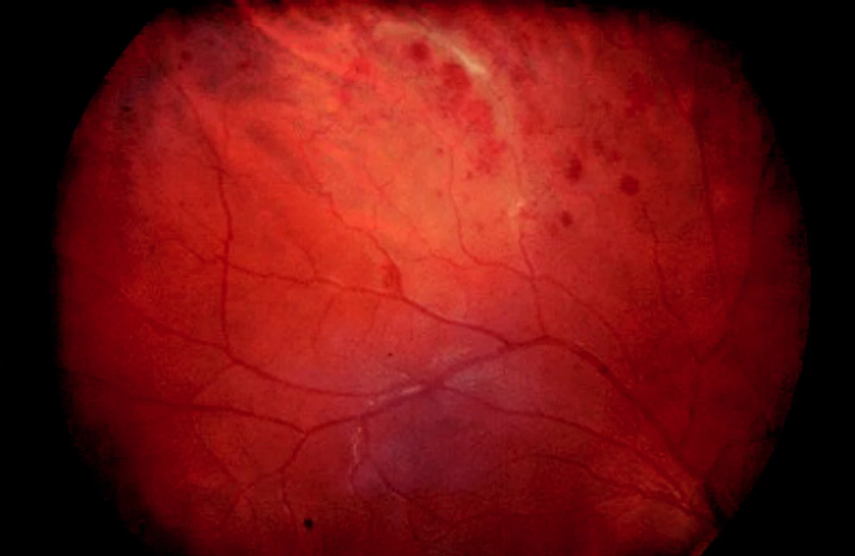 Fundus pravého oka: zúžené, tortuózne retinálne cievy s perivazálnymi exsudátmi, hemoragiami a opúzdrením, hlavne v hornej polovici fundu