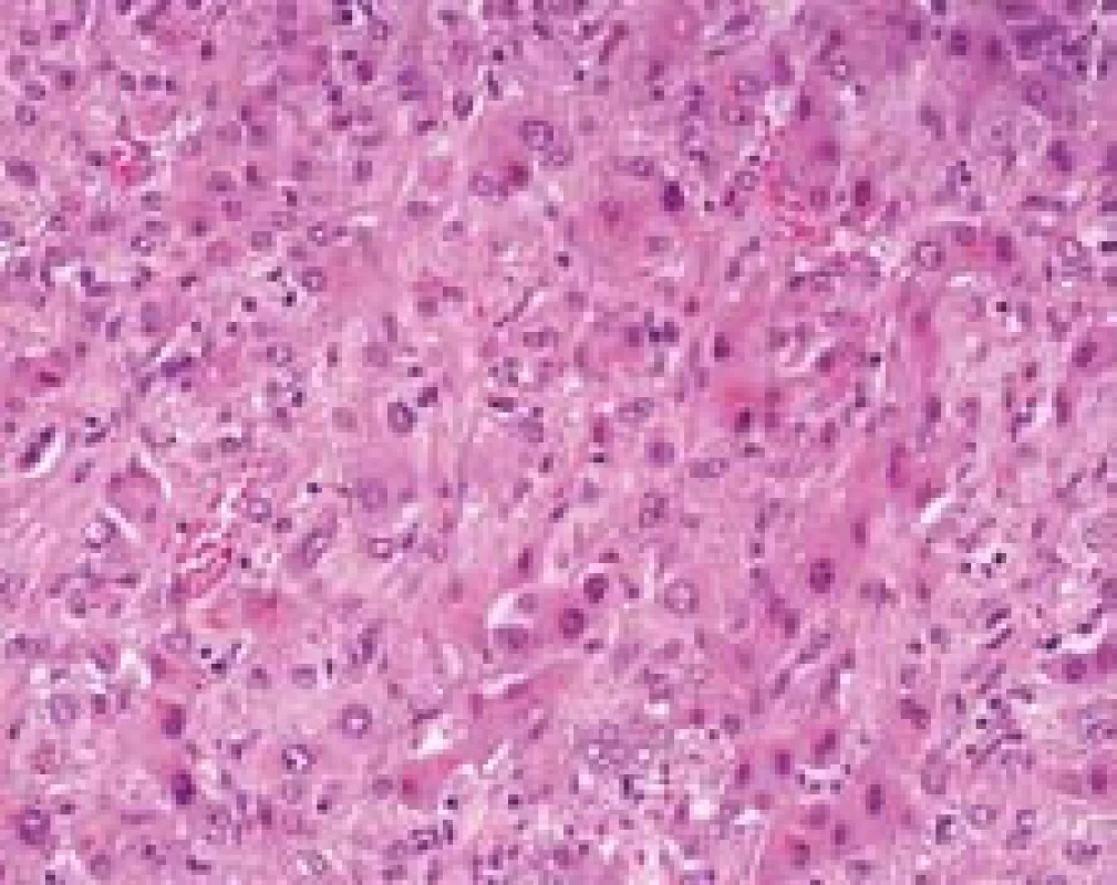 Epiteloidní hemangioendoteliom, nádorové buňky šířící se sinusy a reaktivní změny hepatocytů. Na úrovni HE je velmi obtížné rozpoznat, které elementy jsou vlastně nádorové. Barvení HE, zvětšení  objektiv 40×.
Fig. 5. Epithelioid hemangioendothelioma, tumor cells in the sinusoids and reactive changes of hepatocytes are shown. There is difficult to recognize the tumor cells in the H&amp;E stain. 
