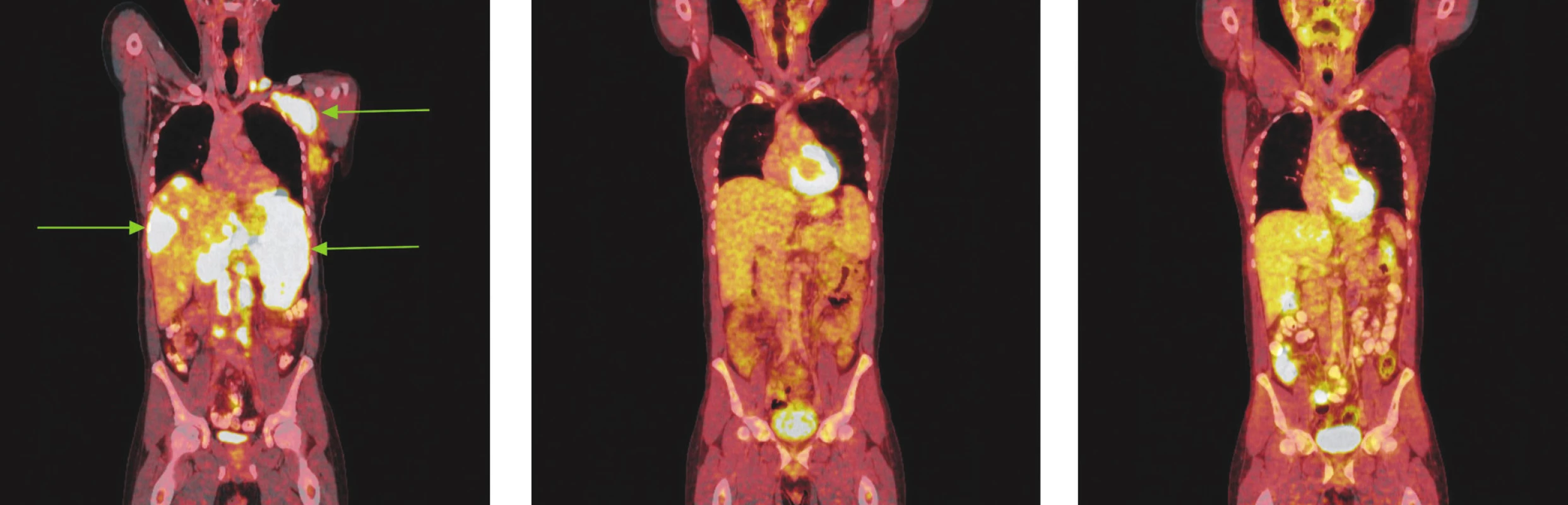 Série PET/CT snímků u nemocného s difuzním B-velkobuněčným lymfomem před léčbou, po 2 cyklech léčby a po ukončení léčby. Na prvním snímku nalezeny pakety lymfatických uzlin v levém nadklíčku a v levé axile vykazující výrazný hypermetabolismus glukózy. Další mnohočetná ložiska hypermetabolismu glukózy byla lokalizována ve skeletu páteře, žeber, ve zvětšené slezině a v játrech. Na druhém snímku po 2 cyklech léčby přetrvávají zvětšené lymfatické uzliny v nadklíčku v axile vlevo, ve srovnání s předchozím vyšetřením však na PET snímcích nevykazují hypermetabolismus glukózy a na CT je patrné, že došlo k jejich zmenšení. Na posledním snímku po dokončení léčby nalezeny pouze zvětšené lymfatické uzliny v levé axile, v ostatních lokalizacích bez patologicky změněných lymfatických uzlin. Hypermetabolismus glukózy svědčící pro viabilní nádorovou tkáň neprokázán.