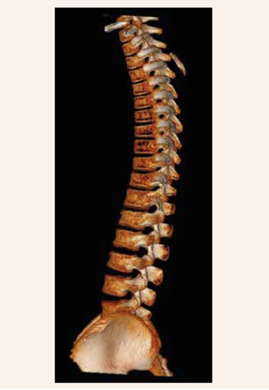CT-vyšetrenie chrbtice (kazuistika 2)