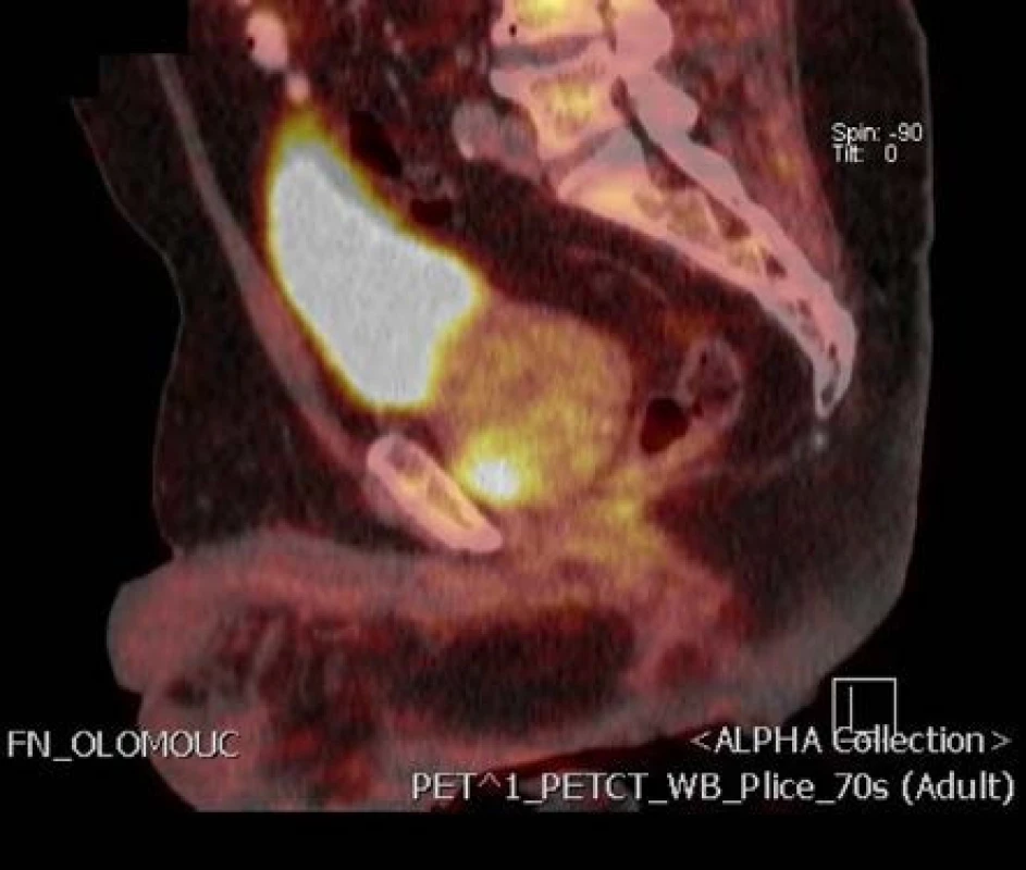 Ložisko tumoru v anteriorní zóně vlevo na 18-F-fluorocholin PET/CT podélný řez
Fig. 2. Focus of the tumor in anterior zone of the prostate on 18F-fluorocholine PET/CT longitudinal section
