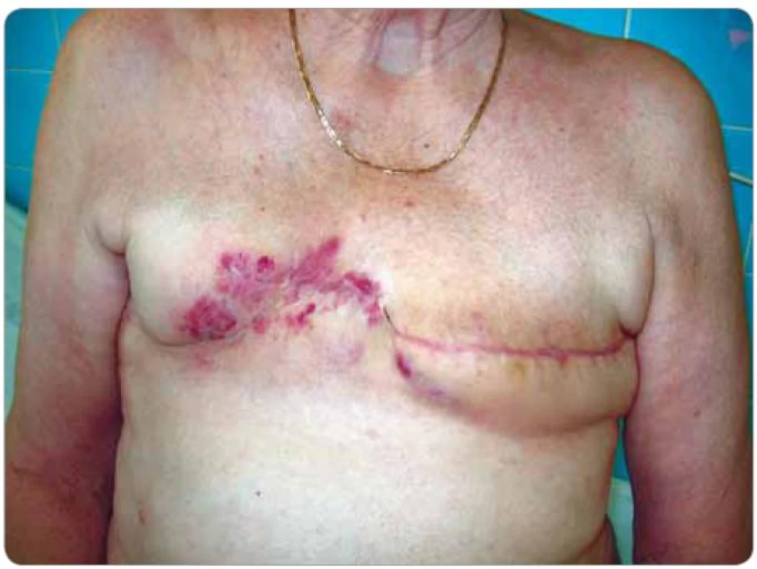 Zarudlé kožní infiltráty ve střední a mediální části jizvy po pravostranné ablaci prsu signalizující recidivu angiosarkomu (pacient č. 1).