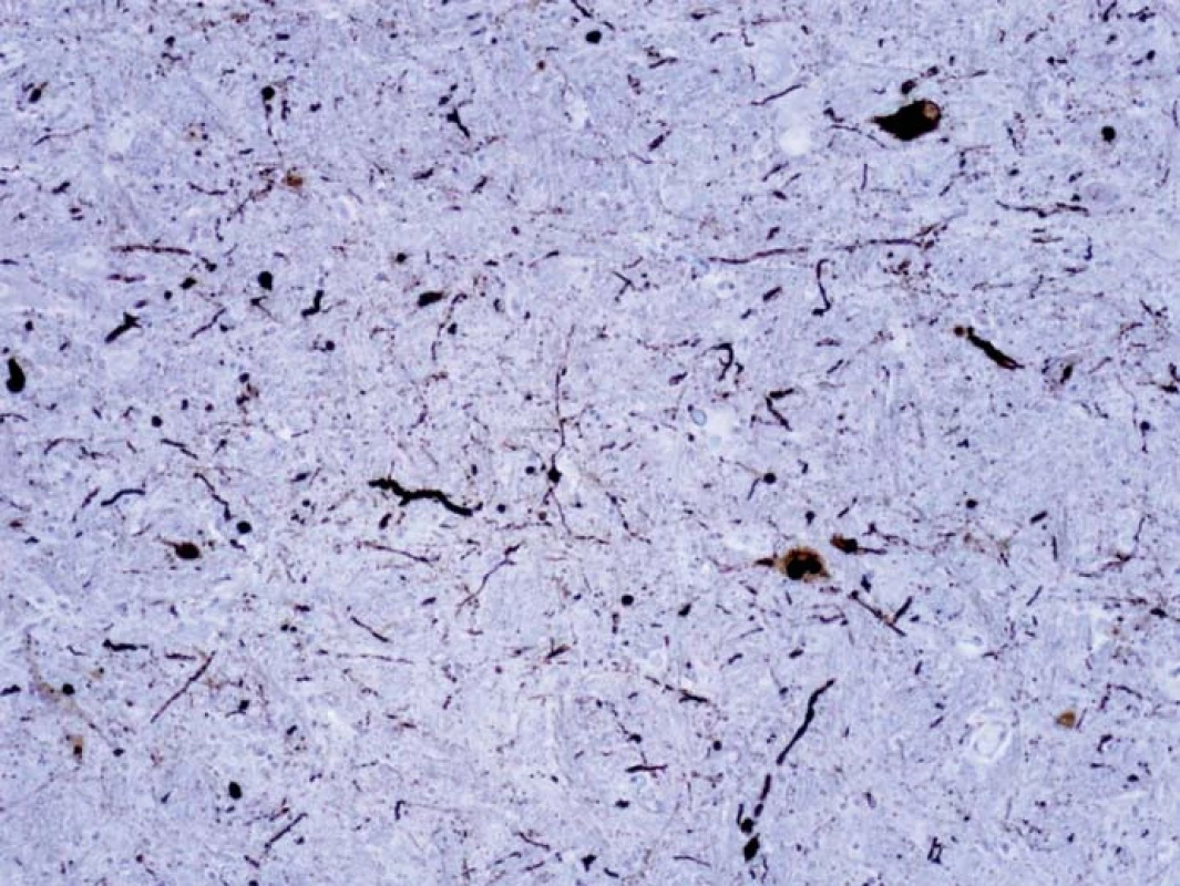 Dystrofické Lewyho neurity v oblongate vizualizované imunohistochemicky farbením alfa-synukleinom. Ojedinele sú patrnné i neuróny s cytoplazmatickými depozitami, tie majú v jednom mieste i charakter Lewyho teliesok.
Fig. 3. Dystrophic Lewy neurites in oblongata visualized by immunohistochemical staining for alpha-synuclein. Neurons with cytoplasmic deposits are rarely seen, these have a character of Lewy bodies in one location.