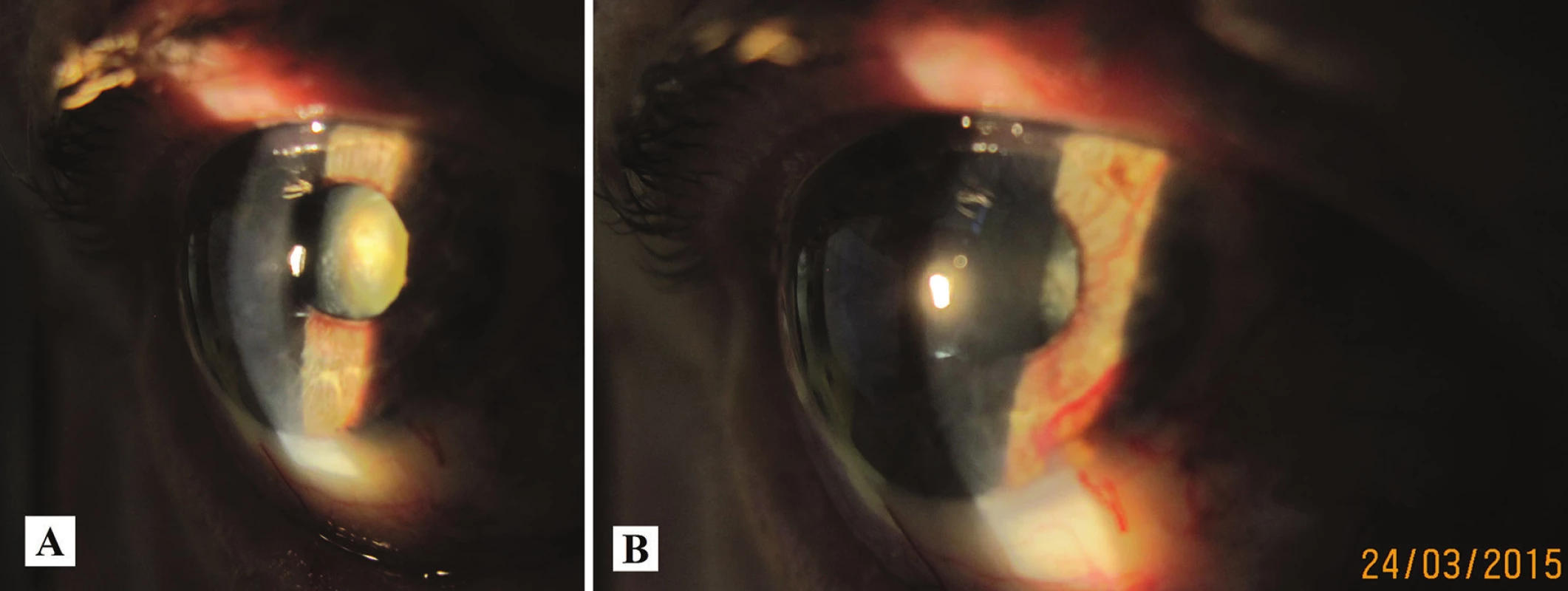 Makrofoto predného segmentu oka toho istého pacienta v r. 2015 – progresia katarakty (A), zvýraznenie neovaskularizácie dúhovky (B)