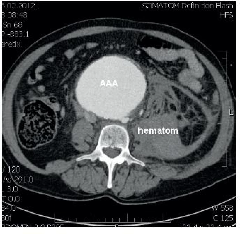 CT ruptury aneurysmatu břišní aorty s retroperitoneálním hematomem