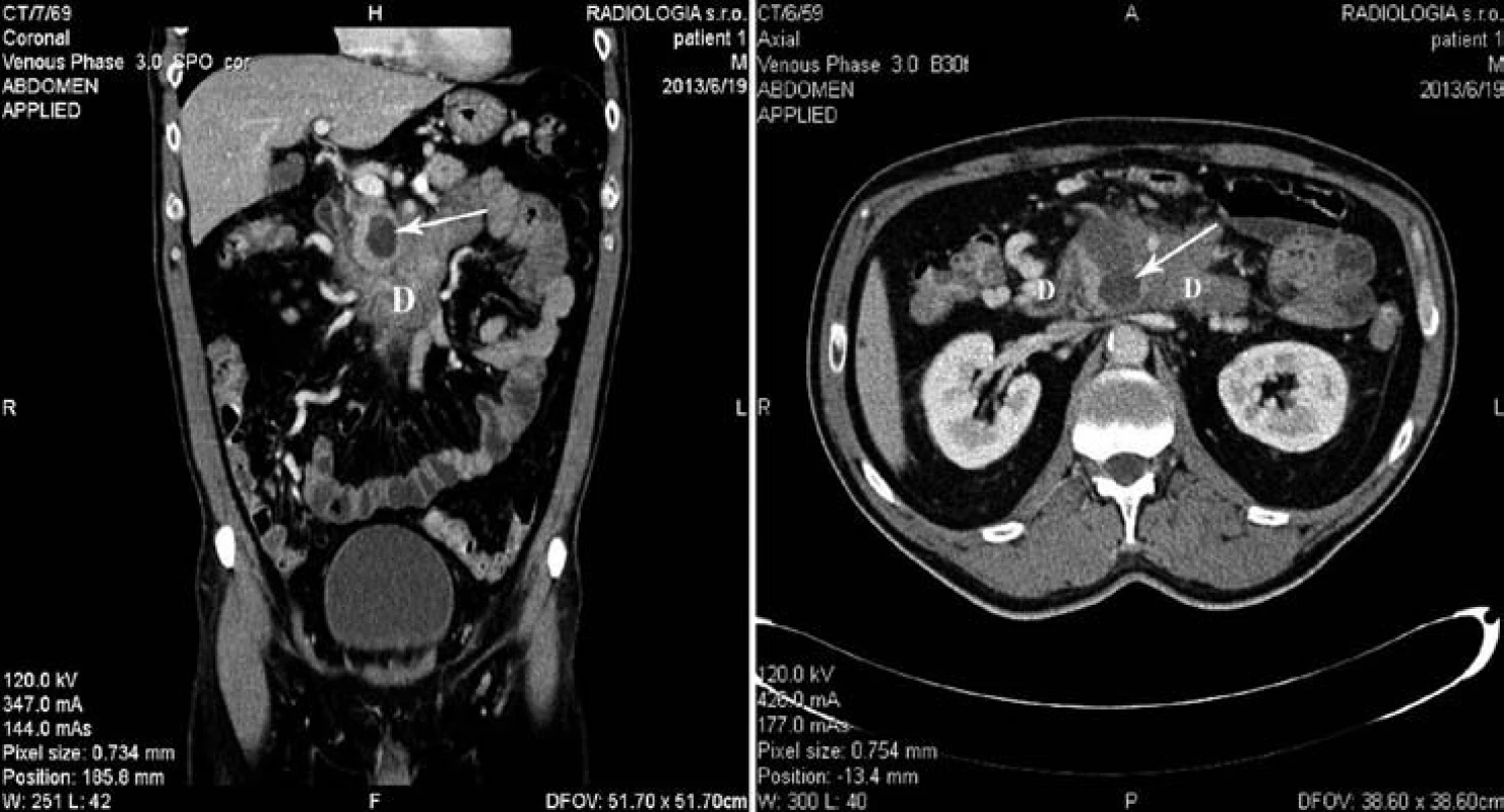 CT vyšetrenie ukázalo tumor hlavy pankreasu s cystickou zložkou (biela šípka) a infiltráciou duodena (D).
Fig. 2. CT scan showed pancreatic head tumor with cystic component (white arrow) and infiltration of the duodenum (D).