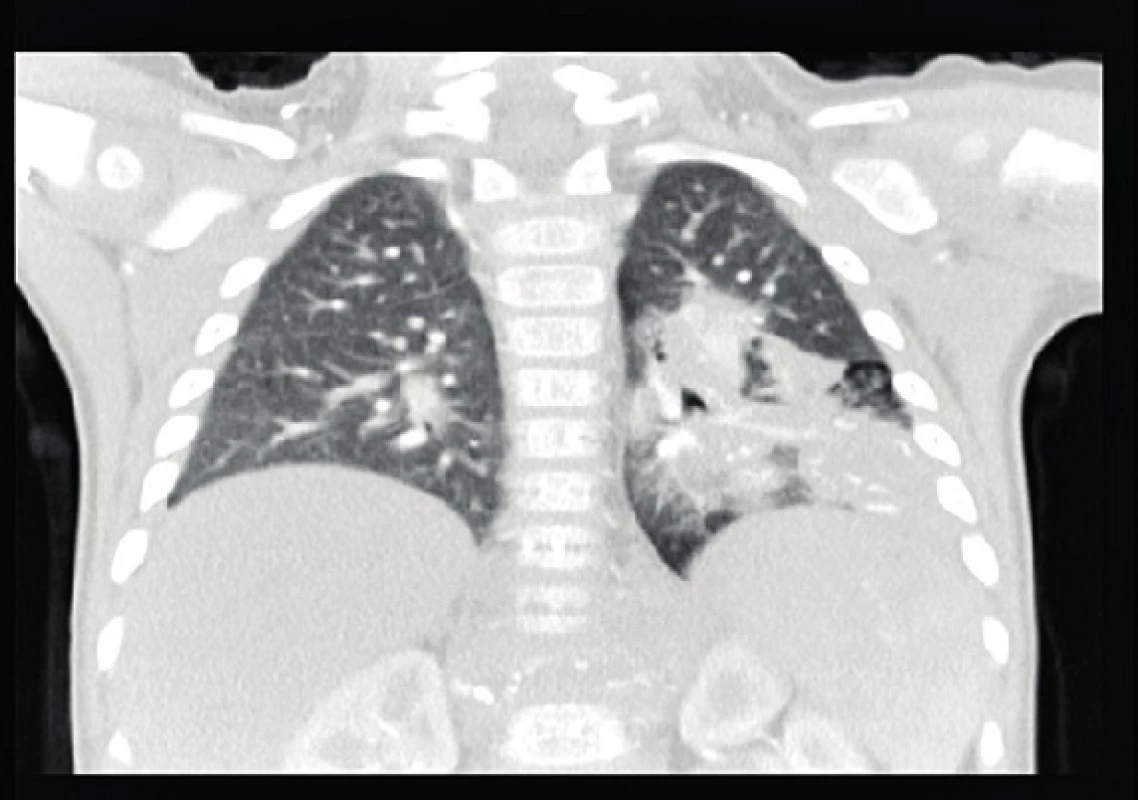 Pneumonický infiltrát v dolnom laloku vľavo.
Fig. 3. Pneumonic infiltrate in inferior lobe l. sin.