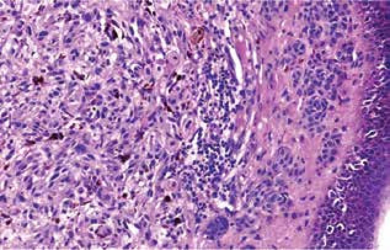 Histologický nález – vlevo melanom, vpravo pod epidermis
proužek névových buněk
V epidermis je melanocytární hyperplazie (HE, zvětšení 400x).