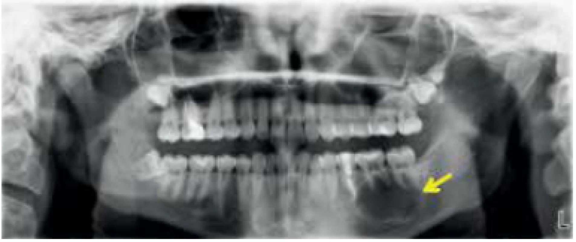 CT nález recidívy tumoru pacientky, panoramatická snímka. Na ľavej strane corpus mandibulae je cystické prejasnenie (šípka).