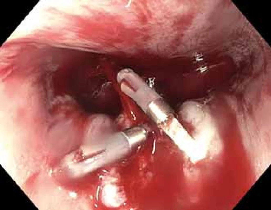 Urgentní ezofagogastroduodenoskopie – masivní krvácení v úrovni aortálního oblouku, ošetřeno klipy.<br> Fig. 1. Emergency esophagogastroduodenoscopy – massive bleeding at the level of aortic arch, treated with hemoclips.