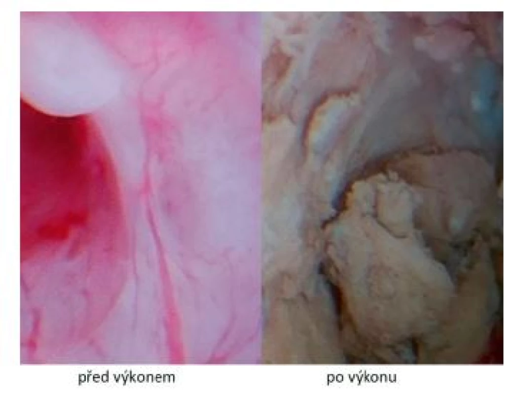 Hysteroskopické vizuální srovnání endometria těsně před
výkonem a po jeho ošetření radiofrekvenční ablací