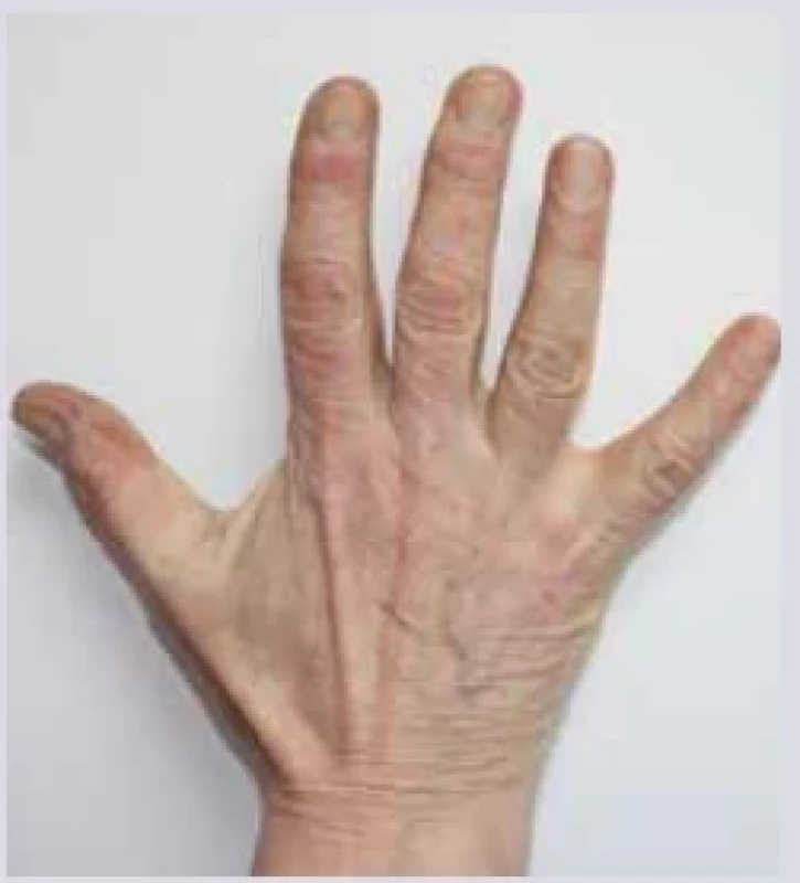 Gottronovy papuly. <br> 
Fig. 16. Gottron papules.