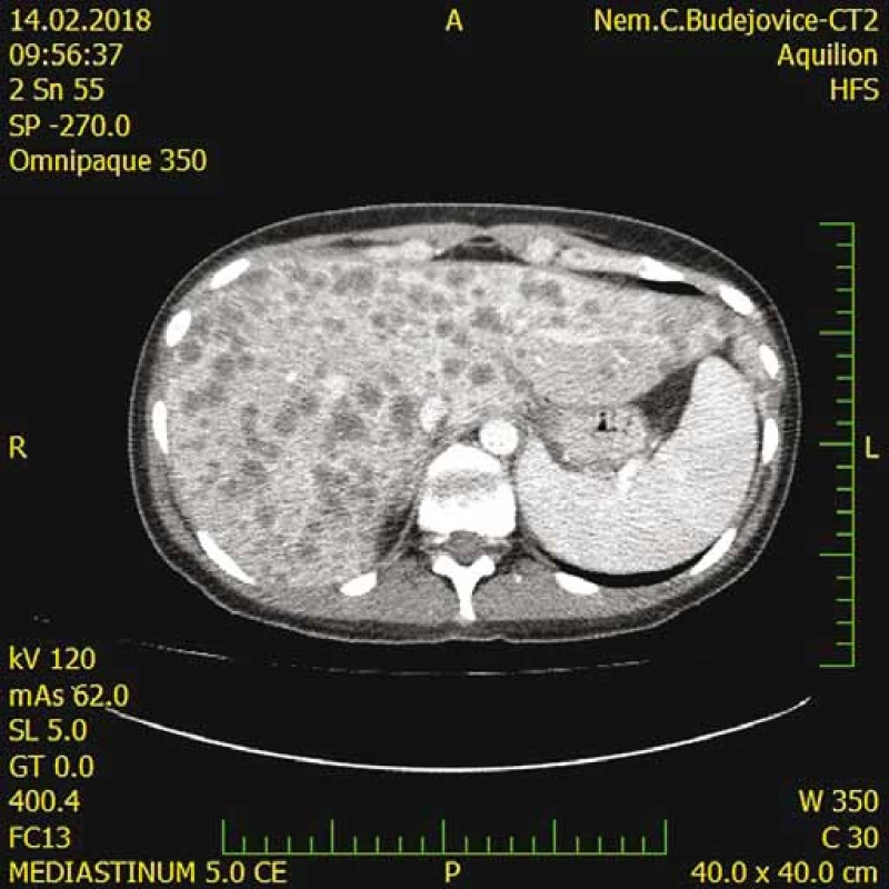 CT s nálezom difúzneho metastatického procesu
pečene.<br>
Fig. 4. CT scan shows diffuse metastatic process in the liver.