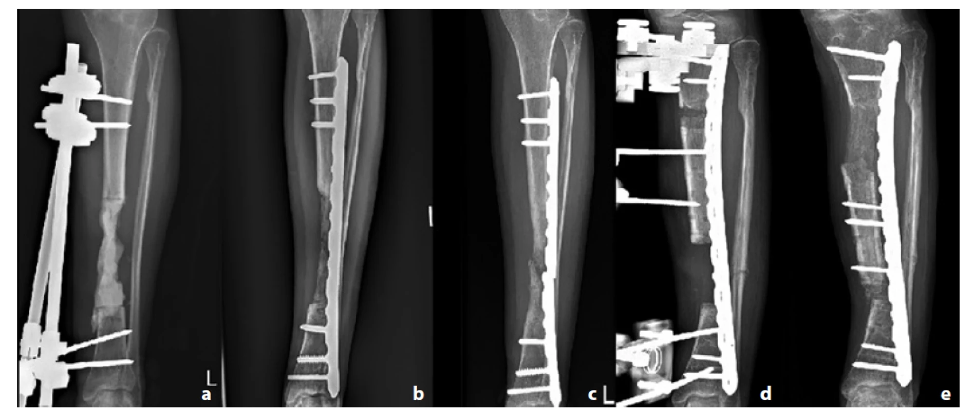 Pacient č. 7; a – PMMA spacer v místě defektu; b – 2 měsíce od spongioplastiky; c – patrná refraktura a selhání dlahy;
d – zvolena technika segmentálního kostního transportu; e – segmentální transport při dosažení kontaktu kostí<br>
Fig. 3: Patient 7; a – PMMA spacer inside the bone defect; b – 2 months after bone grafting; c – refracture and implant failure;
d – segmental bone transport applied; e – segmental bone transport after reaching the docking site.