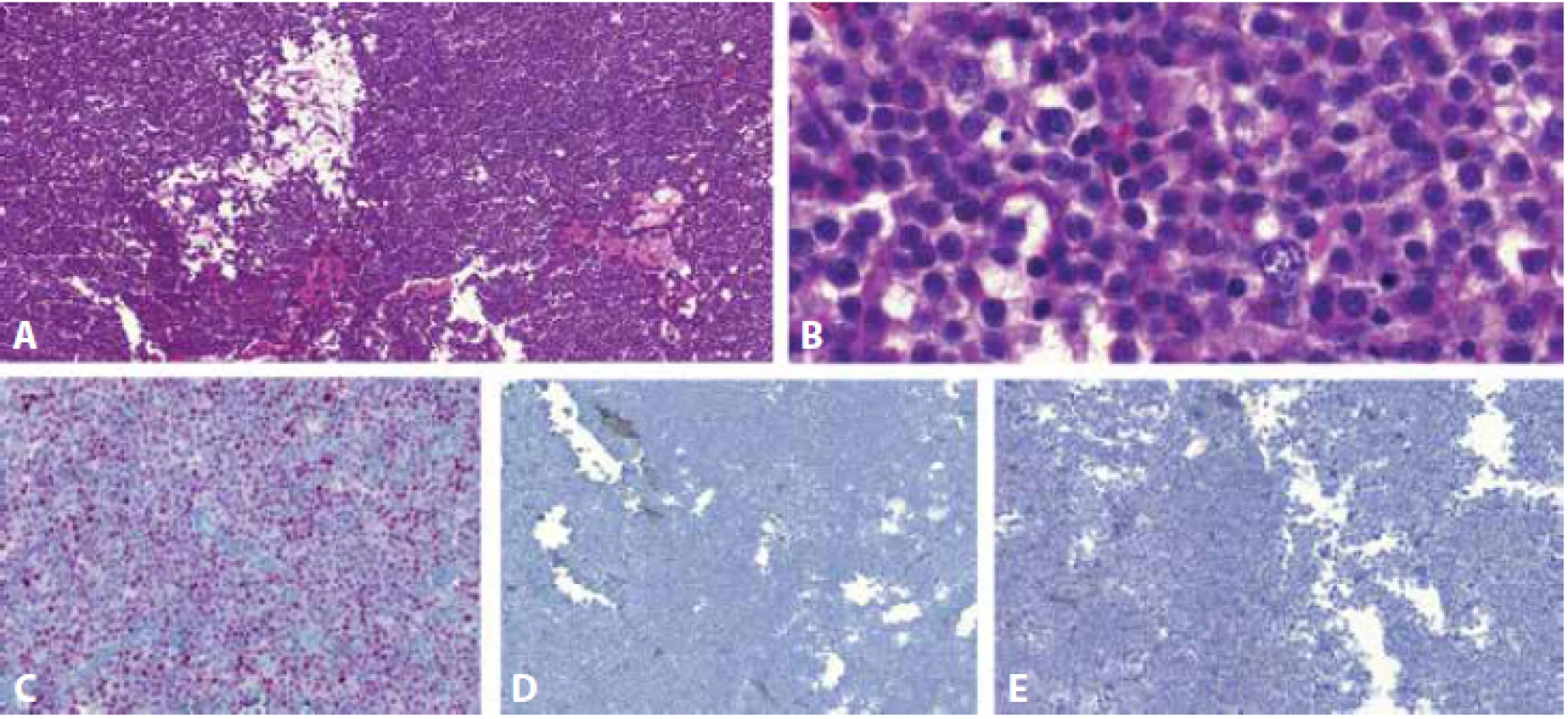 Spermatocytický tumor roste difúzně v edematózním stromatu, charakteristický je takzvaný „potrhaný“ vzhled, viditelný v malém zvětšení (A). Při větším zvětšení jsou patrné pravidelné buňky třech velikostí: 1) nejmenší, připomínající lymfocyty, 2) prostřední, nejpočetnější, velikostně odpovídající buňkám seminomu a 3) největší, často mnohojaderné, dosahující až 100 mikrometrů v průměru (B). Imunohistochemicky jsou nádorové buňky nukleárně pozitivní v průkazu DMRT1 (C) a negativní v reakci s NANOG (D) a OCT3/4 (E).