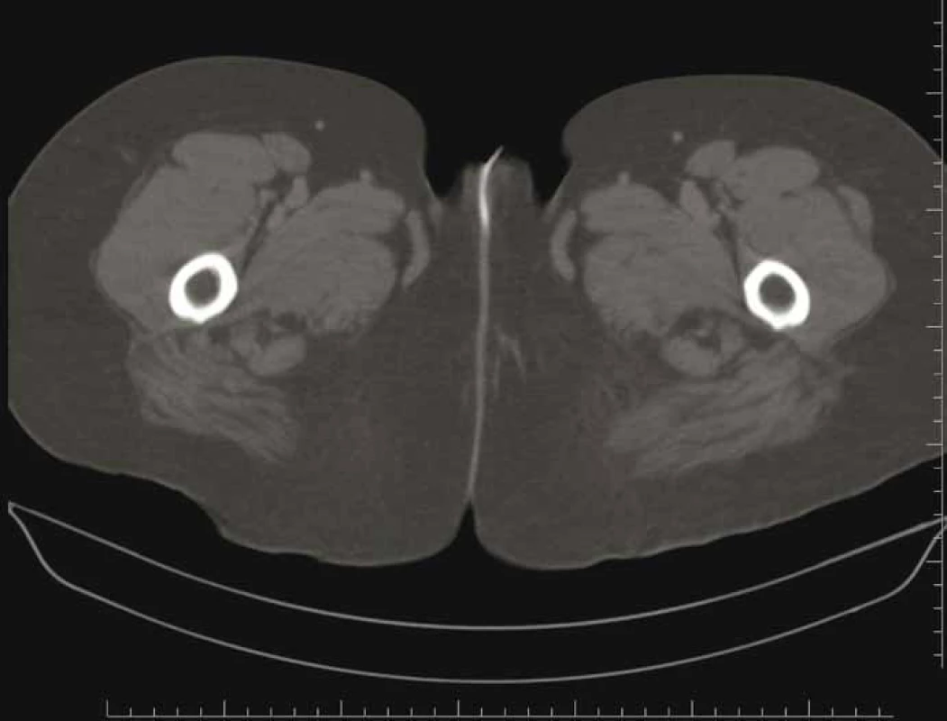 Sagittal abdominal CT.<br>
Obr. 2. Sagitální abdominální CT.