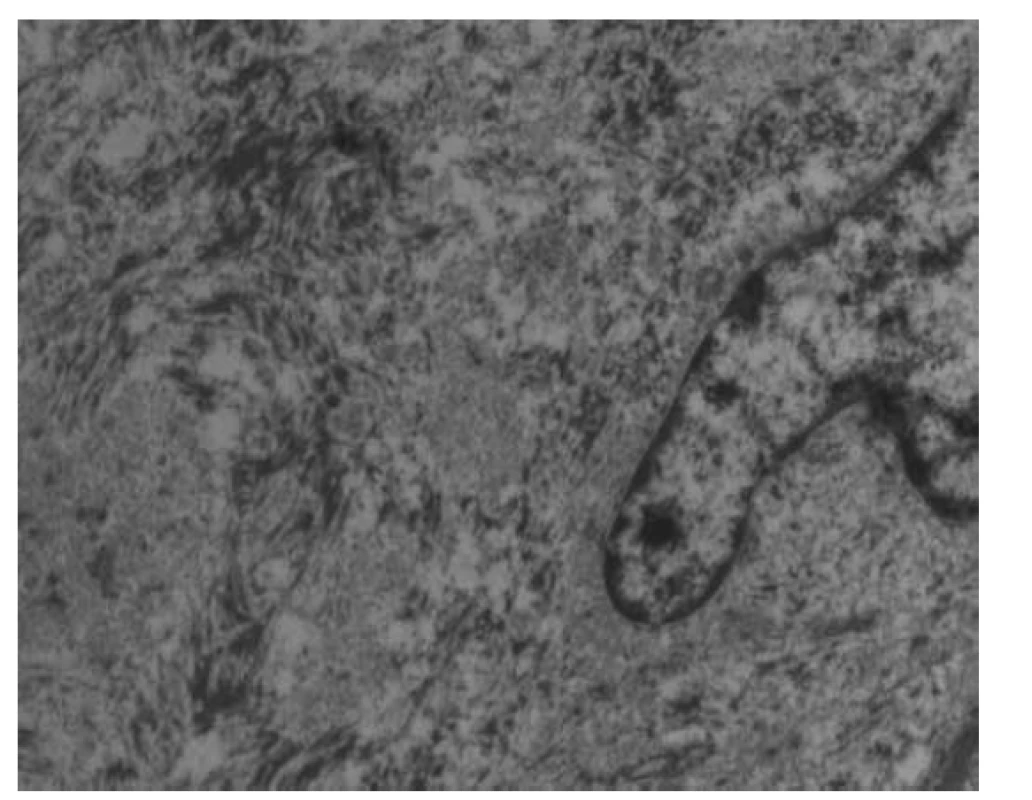 Pohled do nitra gaucherovy buňky v elektronovém mikroskopu
s průkazem intraplazmatického vláknitého materiálu.