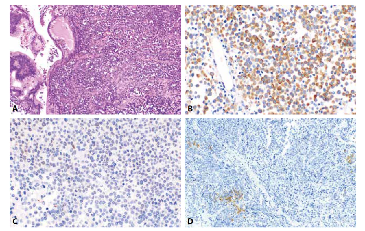 Dediferencovaný karcinom endometria. Struktury dediferencovaného karcinomu tvořeného splývajícími plochami oválných buněk
vzniklého v terénu dobře diferencovaného endometroidního karcinomu s mucinózní diferenciací (5A, HE, 200x). Nádorové buňky vykazují expresi
cytokeratinu 18 (4B, 400x), disperzní převážně slabou expresi PAX8 (5C, 400x) a fokální expresi synaptofyzinu (5D, 200x).