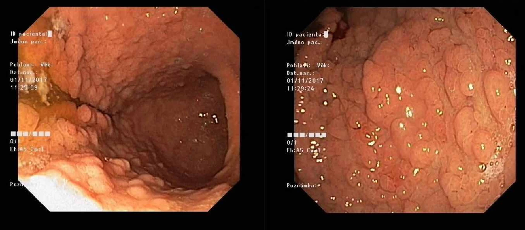Masivní polypóza žaludku u mladého pacienta při syndromu GAPPS před preventivní gastrektomií