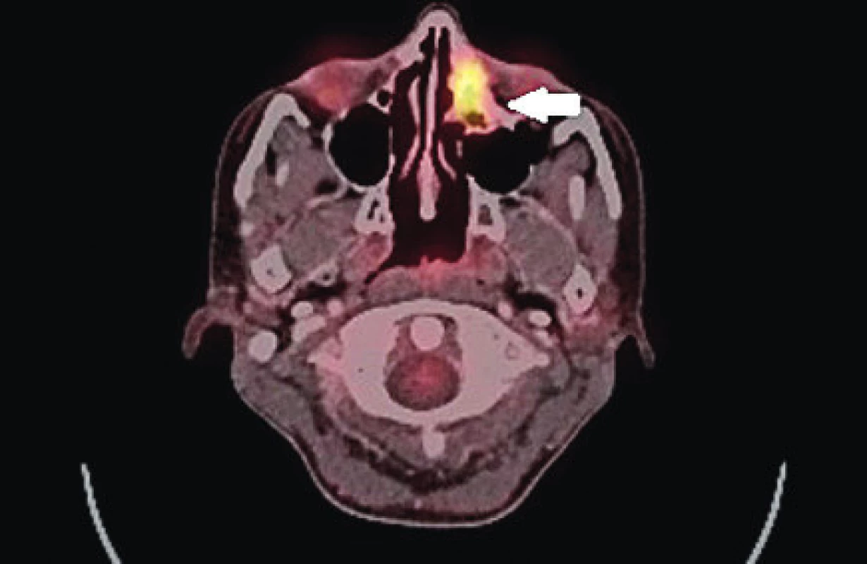 PET/CT vyšetření s akumulací glukózy v předních čichových
sklípcích vlevo.