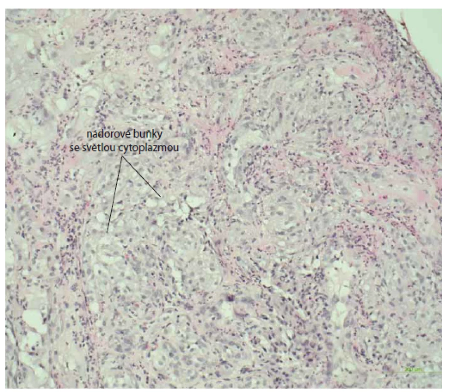 Histologický nález vredu duodena s infi ltráciou nádorových buniek
(metastáza karcinómu obličky), farbenie hematoxin-eozinom, zväčšenie 20×.<br>
Fig. 8. Histological image of a duodenal ulcer with infiltration of tumour cells
(metastasis of renal cell carcinoma), haematoxylin-eosin staining, magnification20?×.