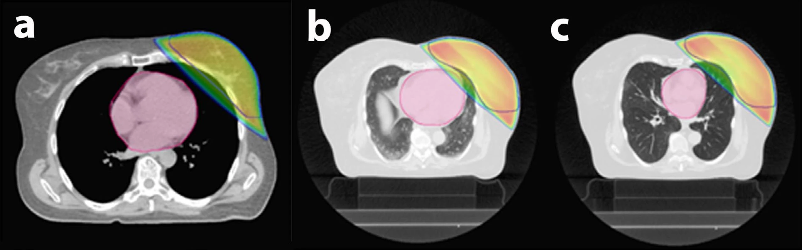 Řízené dýchání při ozařování prsu:<br>
a) Srdce je vzdálené od prsu, nehrozí žádné riziko, standardní 3D technika radioterapie fotony lineárního urychlovače.<br>
b) Srdce leží v blízkosti prsu a část záření skrz něj prochází, proto lékař rozhodne o ozařování v nádechu.<br>
c) Ozařování v nádechu („řízené dýchání“) – na ozařovacím plánu je patrné výrazné zlepšení ve smyslu ochrany srdce před zářením.<br>
Barevné linie v obrázcích: růžová barva – srdce; modrá linie – objem ozařovaného prsu; barevná plocha – ozářená oblast.