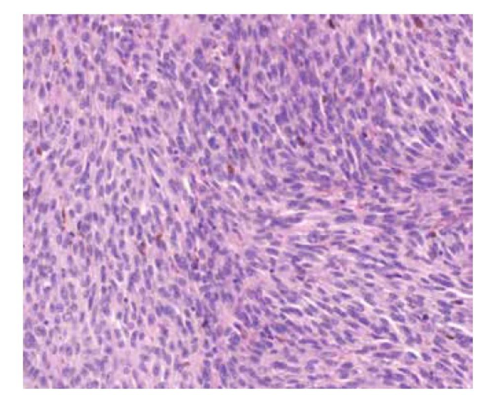 Mikroskopický snímek po obarvení hematoxylinem
a eosinem – patrné jsou vřetenité nádorové buňky s hnědými granuly
pigmentu melaninu