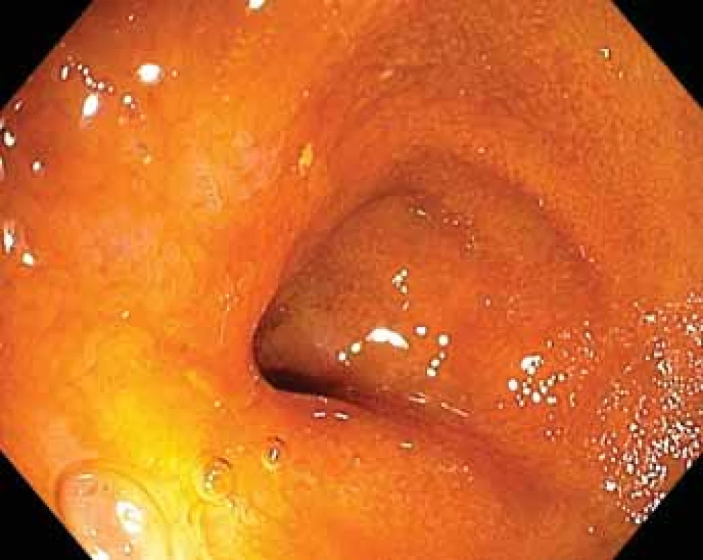 Kontrolní enteroskopie s odstupem 6 měsíců – jizva
po léčbě lymfomu na obr. 4.<br>
Fig. 5. Follow-up enteroscopy in 6 months – scarring after
suc cessful lymphoma treatment (Fig. 4).