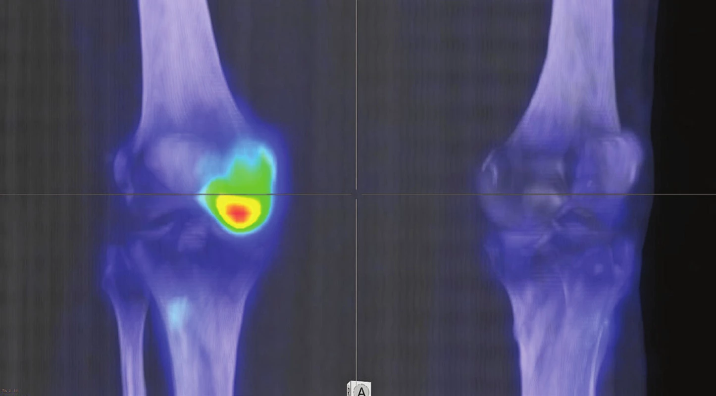 3D rekonstrukce fúzovaného SPECT/CT obrazu u téhož pacienta
s osteonekrózou mediálního kondylu femuru v časném stádiu (I).