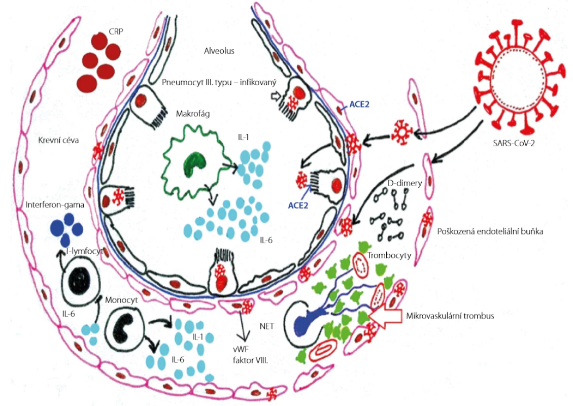 Interakce endotelu a koagulačního systému indukovaná onemocněním SARS-CoV-2 (19). Překresleno MUDr. Simona Bílková
