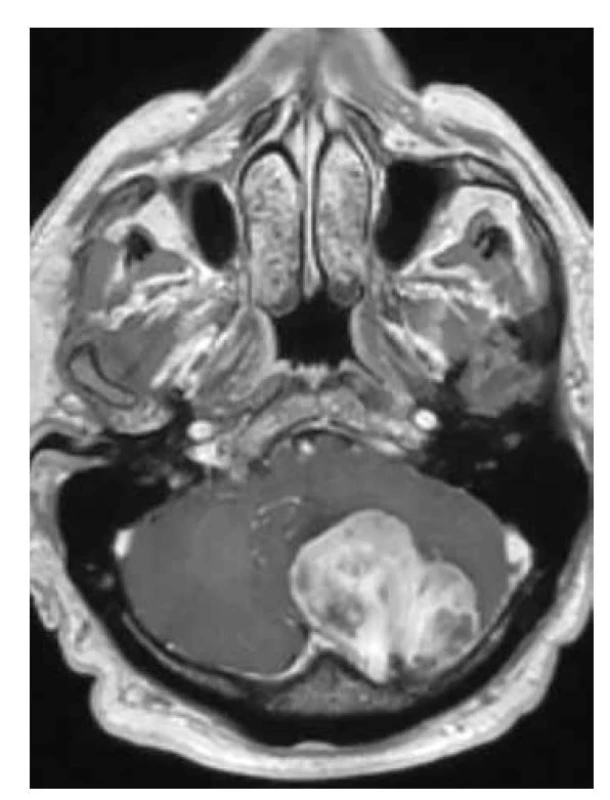 Solitární fibrózní tumor T1W+kontrast: intenzivní sycení tumoru
zadní jámy lební, s výpadky sycení v kalcifikovaných částech, infiltrace přes
duru do diploe kalvy.