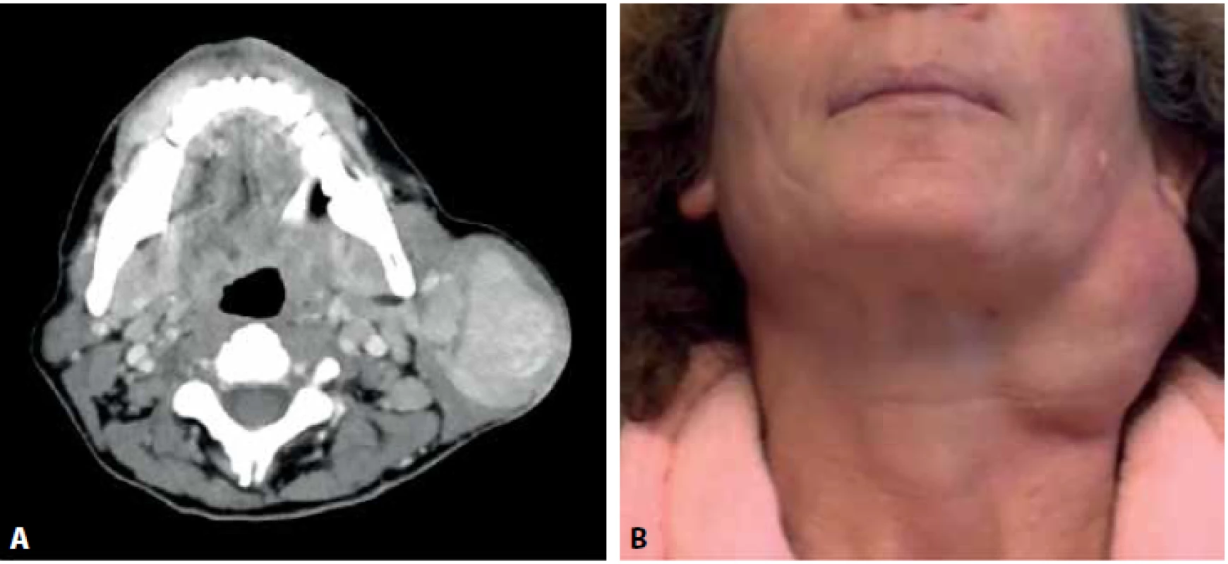 A: CT vyšetření s nálezem hypotenzního ostře ohraničeného multinodulárního útvaru v povrchovém listu levé příušní žlázy se stejnostrannou lymfadenopatií. B: fotografie nemocné se zjevným multinodulárním tumorem příušní žlázy.