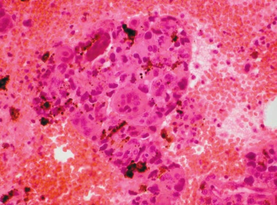 Hemoragický náterový preparát obsahoval relatívne kohezívne skupiny
objemných polymorfných buniek s ružovou cytoplazmou, s jadrovou
pleiomorfiou a s hyperchromáziou. Ojedinele boli prítomné aj viacjadrové
bunky (hematoxylin-eozín, 400x).