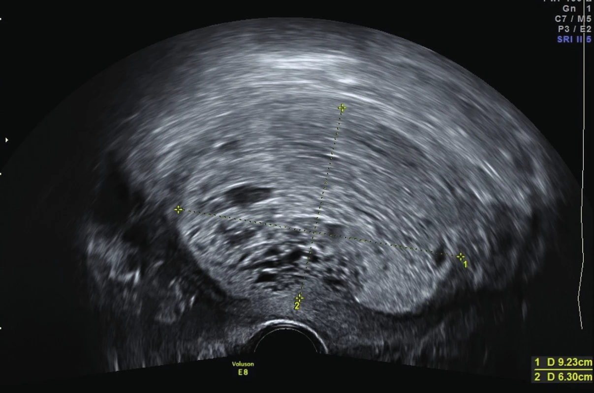 Suspektní tumor dělohy – vaginální pohled