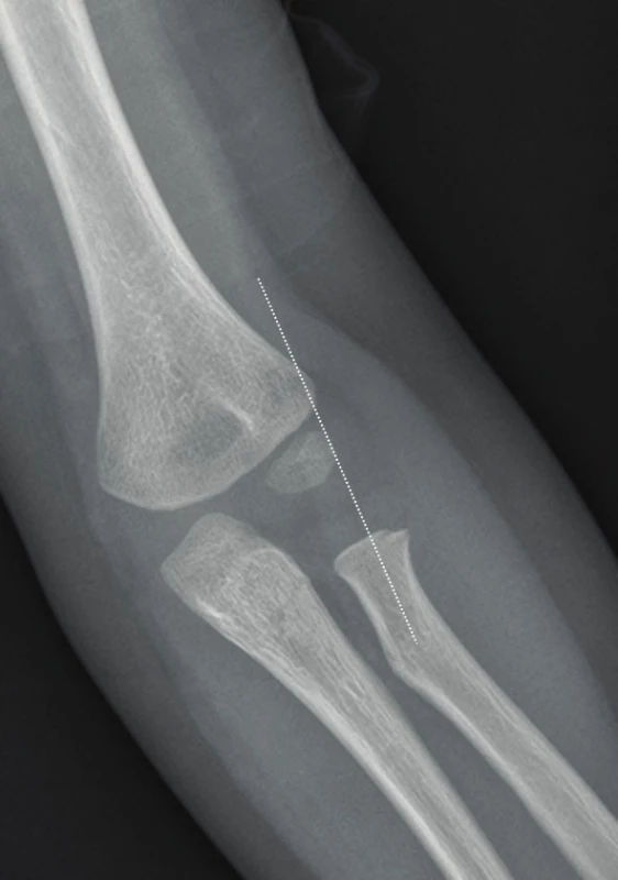  Healthy elbow joint with a false positive image of humeroradial dislocation, boy, 3 years of age