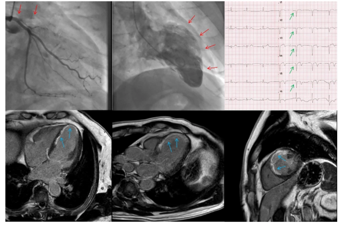 CTO ramus interventricularis anterior (RIA); vlevo nahoře angiografie, ostiální uzávěr RIA, nahoře uprostřed akineza přední stěny a hrotu levé
komory při levostranné ventrikulografii (červené šipky); vpravo nahoře EKG s patologickými Q kmity v oblasti přední stěny srdeční (zelené šipky); dole
snímky z magnetické rezonance s bíle vyznačeným převážně transmurálním postižením dané oblasti v LGE sekvenci (modré šipky) – CTO nevhodné
k intervenci