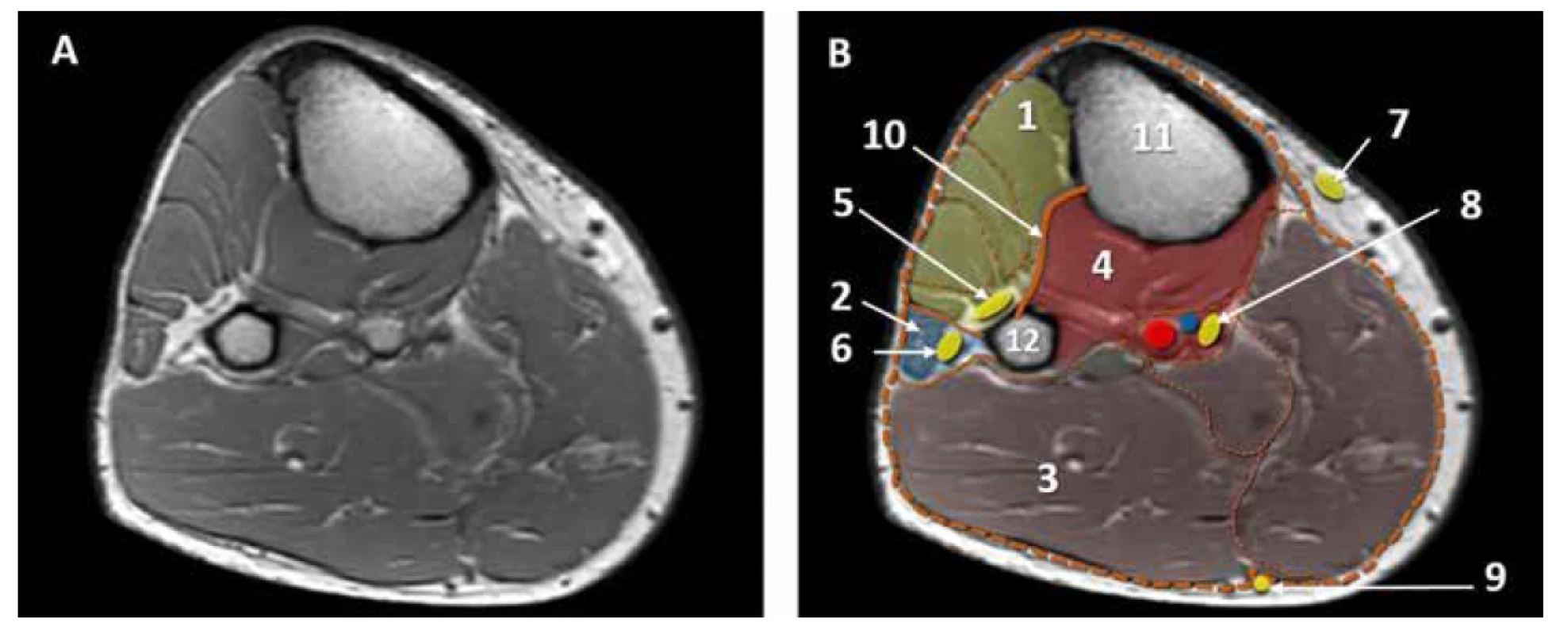 MRI horizontální řez lýtkem, lýtkové kompartmenty. A. nativní obraz. B. kolorovaný obraz: 1. přední kompartment, 2. laterální kompartment,
3. zadní povrchní kompartment, 4. zadní hluboký kompartment, 5. n. peroneus profundus, 6. n. peroneus superficialis, 7. n. saphenus, 8. n. tibialis. 9. n. suralis,
10. membrana interossea, 11. tibie, 12. fibula