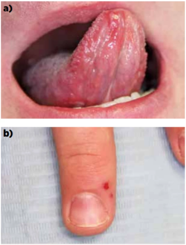 Hand-foot-and-mouth disease: a – postižení sliznice
dutiny ústní, b – postižení kůže