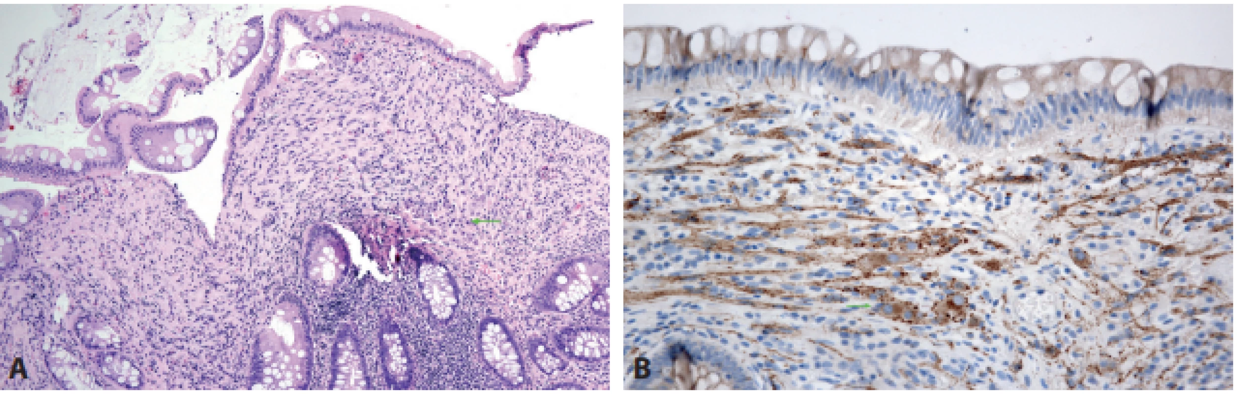 Ganglioneurom.V tomto ganglioneuromatózním polypu od pacientky se syndromem Cowdenové jsou v převažující vřetenobuněčné
proliferaci v proprii zastiženy nečetné drobné skupiny gangliových buněk (A – šipka, HE, 200x). Opticky lze gangliové buňky zvýraznit protilátkou
proti synaptofyzinu (B – šipka, 400x).