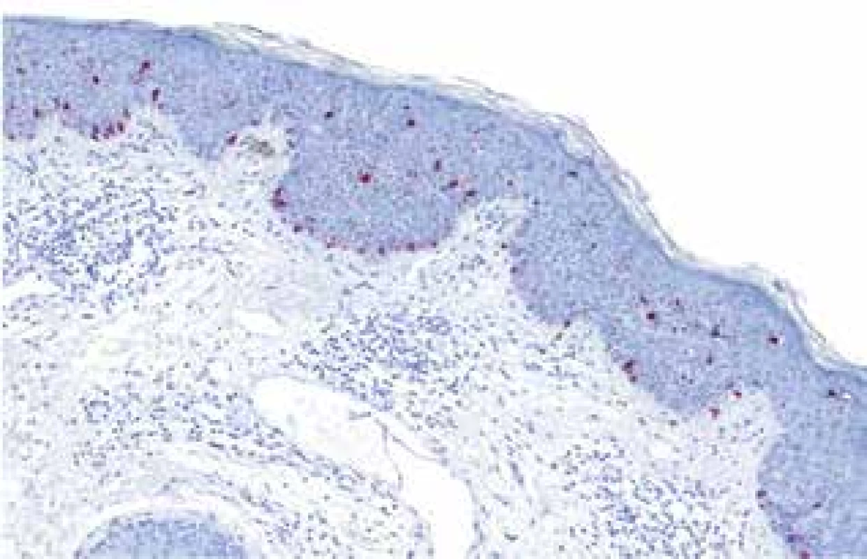 Imunohistochemické vyšetření melanocytárním markerem
tyrozinázou, která červeně značí kolonizaci dysplastického
epitelu dendritickými melanocyty