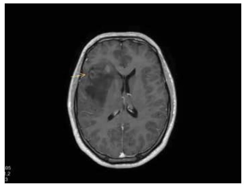 Astrocytom gr. 2 IDH-mutovaný, T1W+kontrast: nehomogenní sycení
ve ventrální části infiltrace, postihující pravou inzulu.