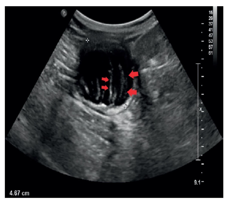 UZ obraz mukokély apendixu – transverzálně<br>
Sonografie břicha. V oblasti céka tubulární, převážně anechogenní
útvar, který je částečně vyplněn echogenním obsahem
(červené šipky). Klinika radiologie a nukleární medicíny FN
Brno a LF MU.<br>
Fig. 1: Ultrasound image of appendiceal mucocele – transverse
projection<br>
Sonography of the abdomen. A tubular, mostly anechogenic
formation is present in the area of the cecum, which is partially
filled with echogenic content (red arrows). Department
of Radiology and Nuclear Medicine, University Hospital Brno,
Faculty of Medicine, Masaryk University.