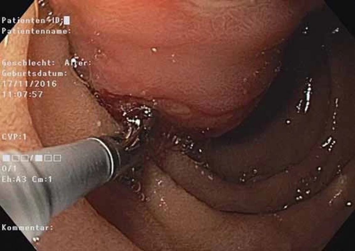 EGD – stopka polypu duodéna s povrchovými ulceráciami.<br>Fig. 2. EGD – pedicle of a duodenal polyp with superficial ulcerations.