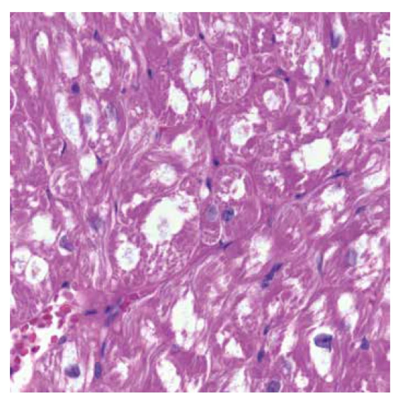 Endomyokardiální biopsie. Detail předchozího snímku s nápadnou
vakuolizací cytoplasmy hypertrofických kardiomyocytů (HE, objektiv 40x).