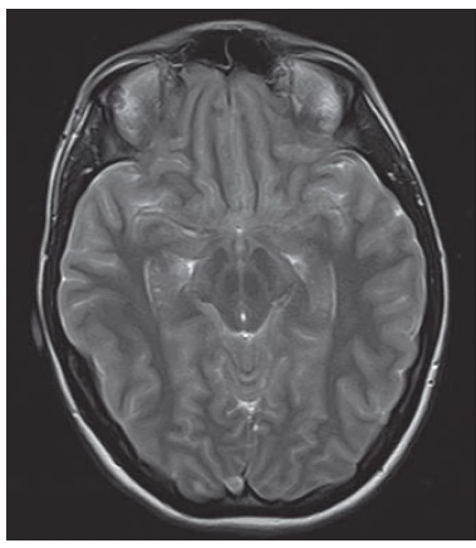 Obr. 2. MR mozku, T1 vážený obraz
sagitální. Prominence kaudálních částí
mozečku intraspinálně, zúžení IV. komory.<br>
Fig. 2. MRI of the brain, T1-weighted
image, sagittal plane. Caudal displacement
of cerebellar tonsils, narrowing of the fourth
ventricle.