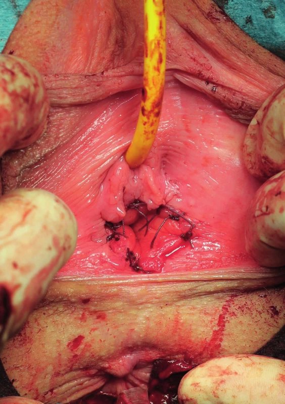 Peroperační snímek závěru operace – cirkulárně naložené
střednědobě resorbovatelné stehy vagino-vestibulární anastamózy