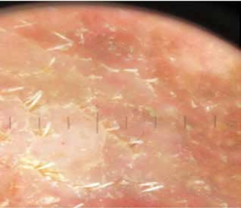 Dermatoskopický obraz světlejšího útvaru pod bradou –
šupící povrch, v horní a pravé části obrázku drobné hnědé tečky
a globule, tečkovité cévy v horní a dolní části